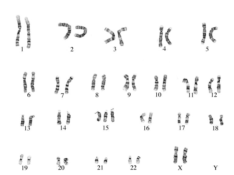 Кариотипы птиц. Кариотип при синдроме Эдвардса. Синдром Патау кариотип. Синдром Патау кариограмма. Болезнь Патау кариотип.