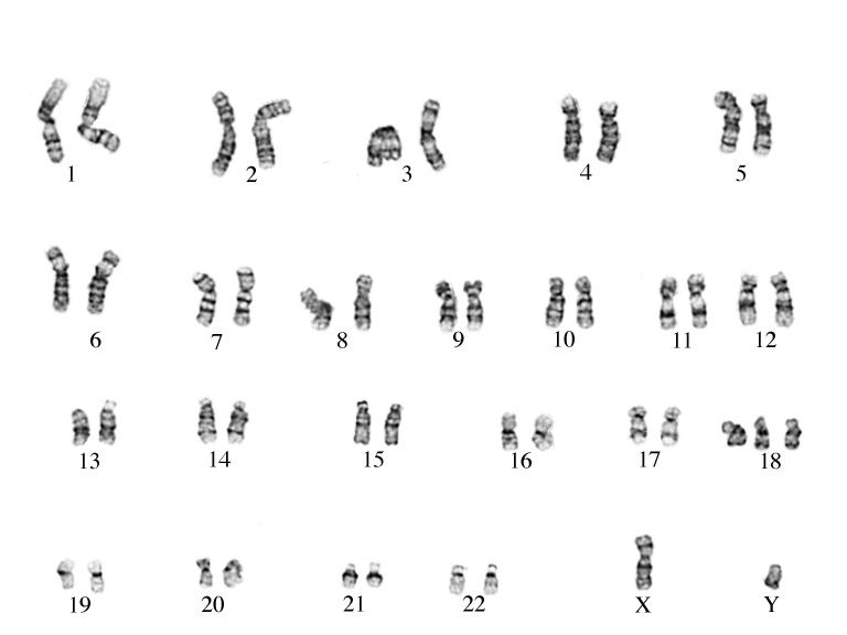 Кариотип эритроцита собаки. Синдром Эдвардса кариотип. Кариограмма синдрома Эдвардса. Синдром Ангельмана кариотип.